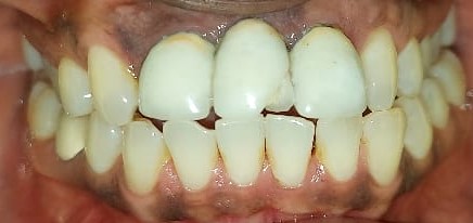 Before