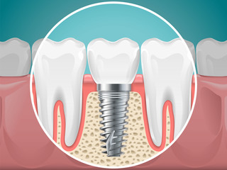 brace