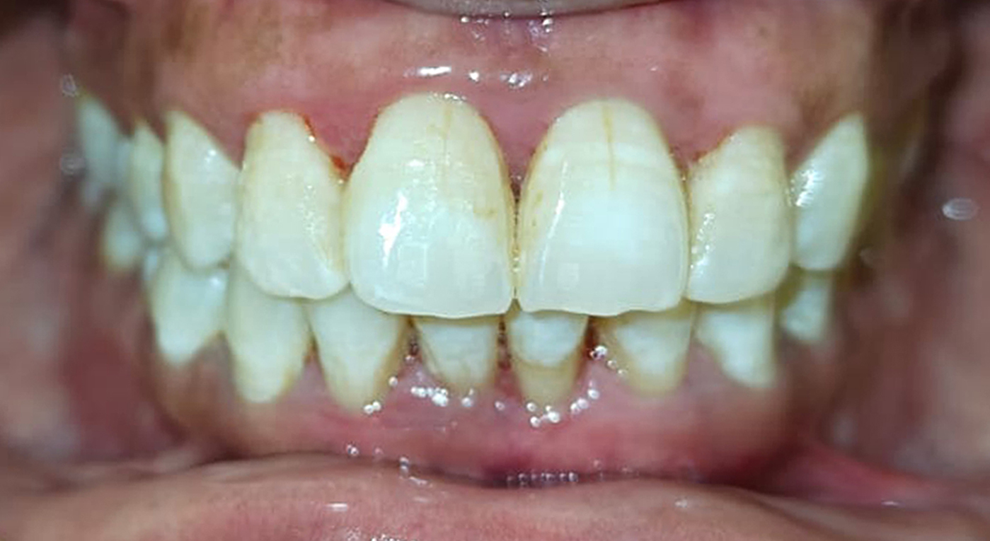 After laser deep cleaning