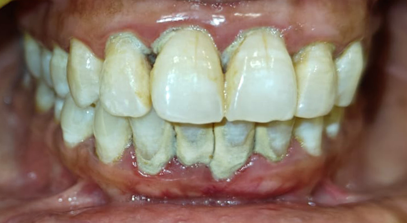 Before laser deep cleaning
