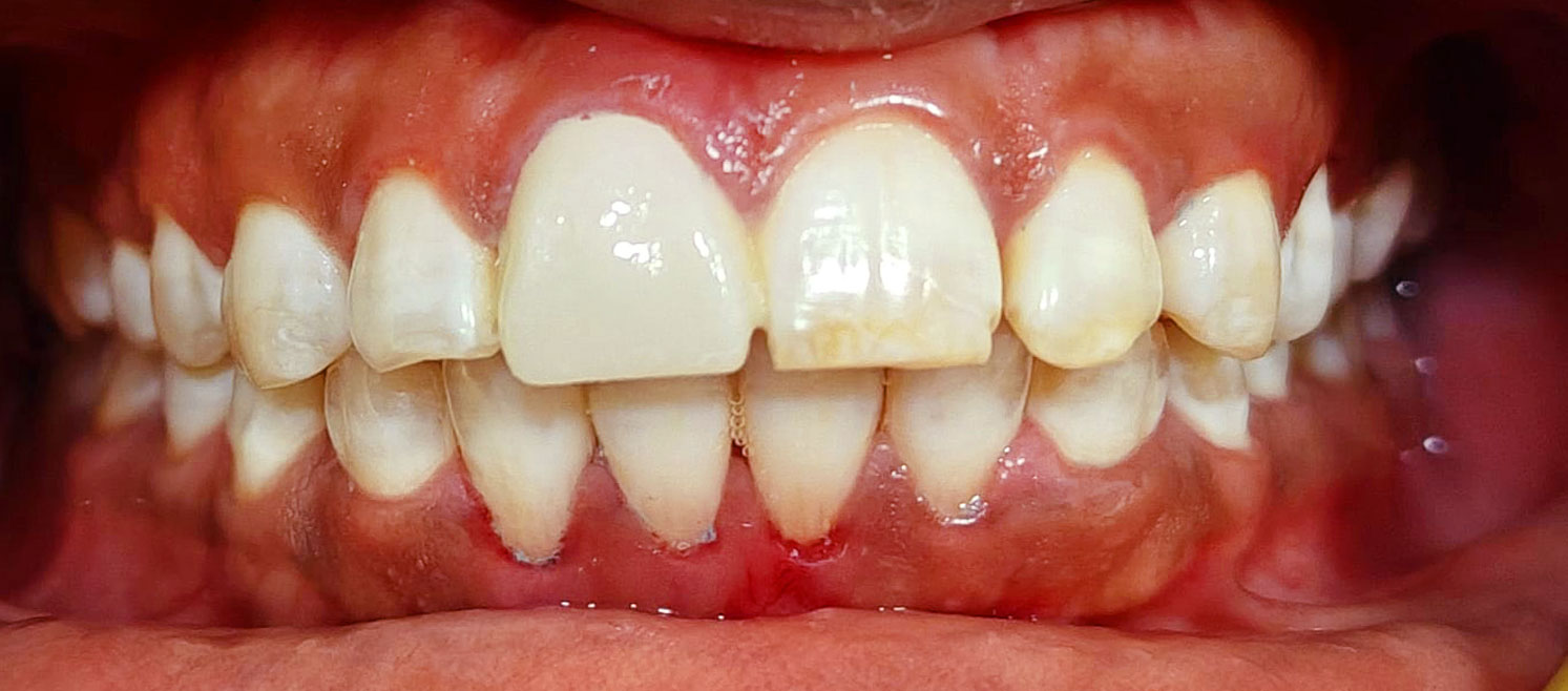 After crown lengthening