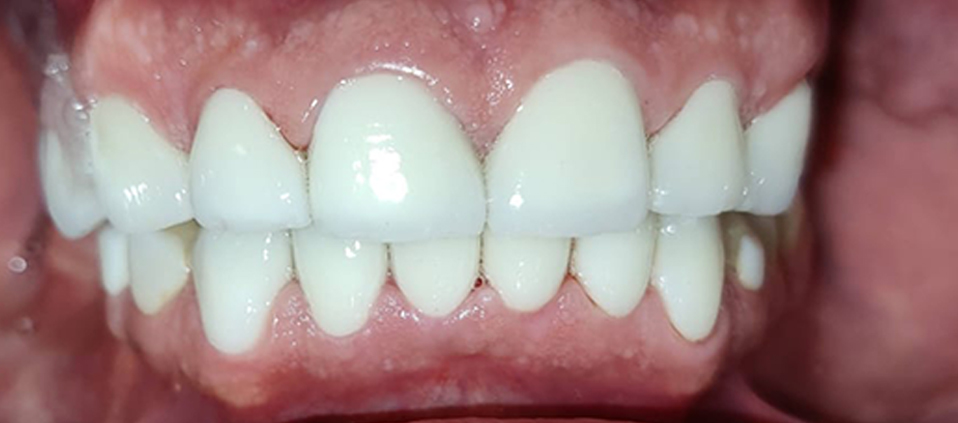 After Zirconia crown placement