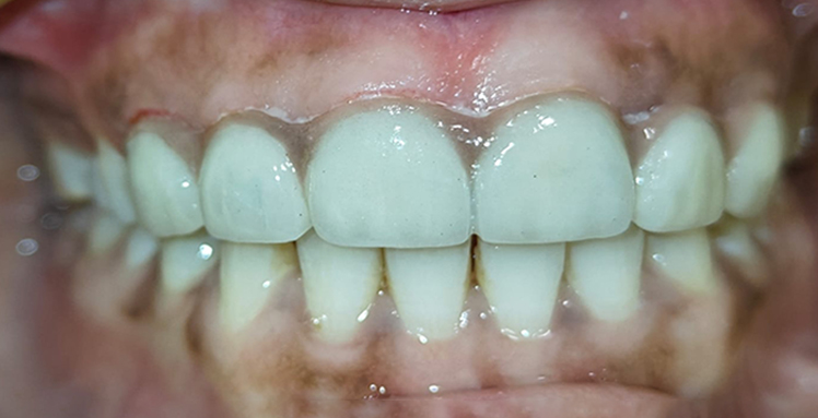 After dental veneers spacing correction