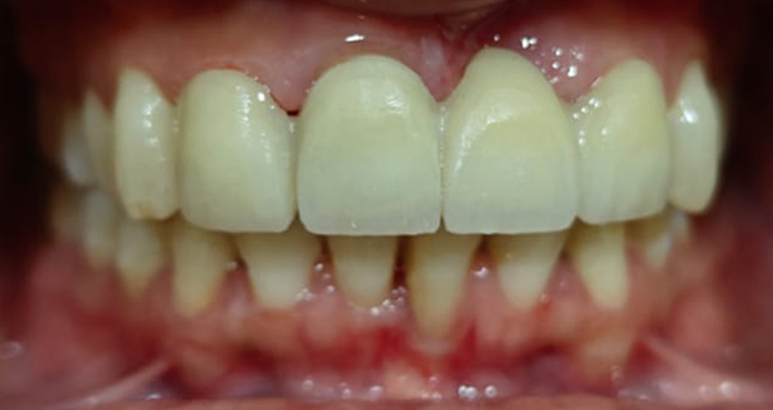 After Zirconia crown placement