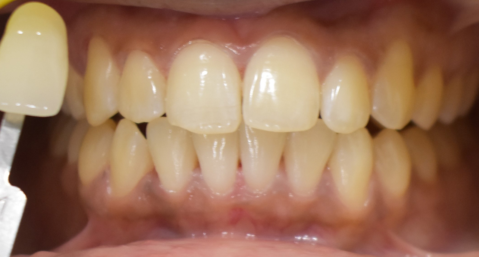 Before teeth whitening