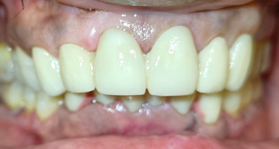 After crowding correction alignment