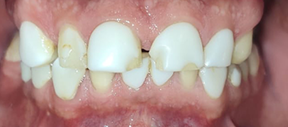 Before Zirconia crown placement