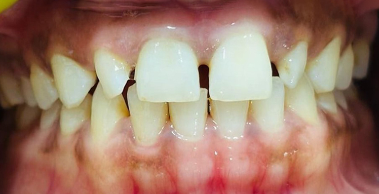 Before dental veneers spacing correction