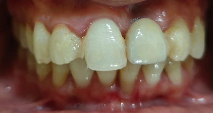 Before Zirconia crown placement