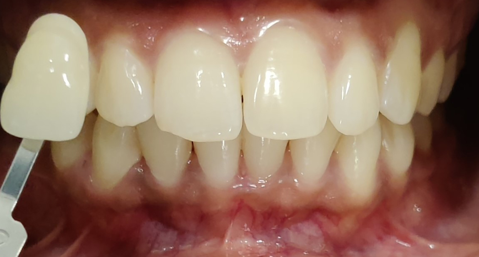 After teeth whitening