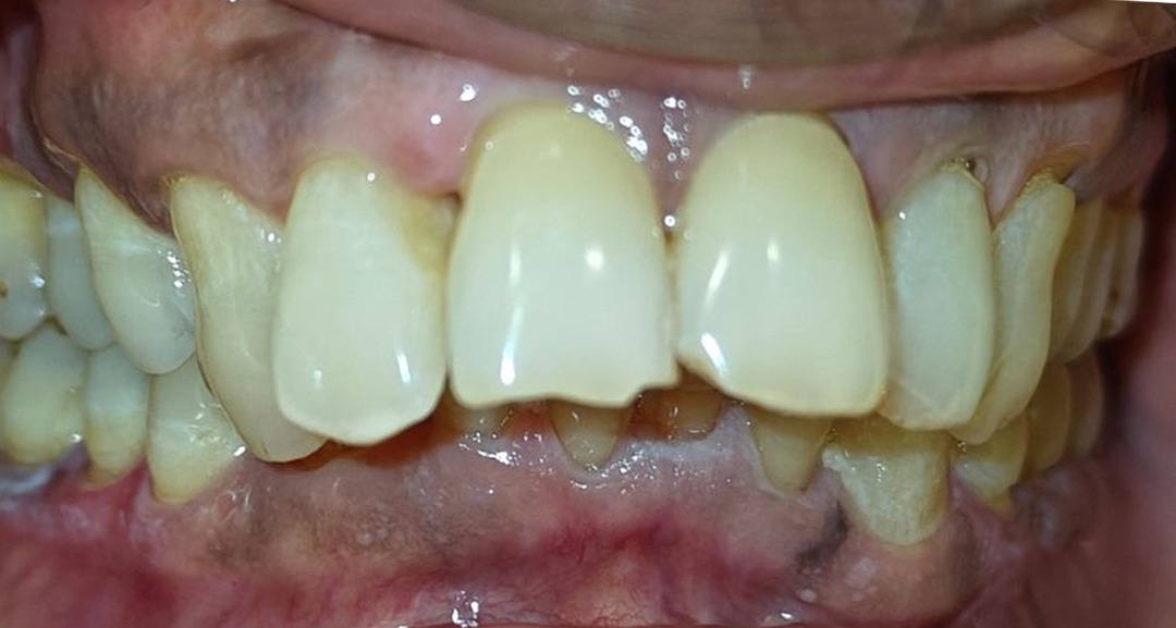 Before crowding correction alignment