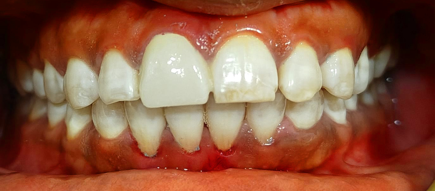 After teeth whitening