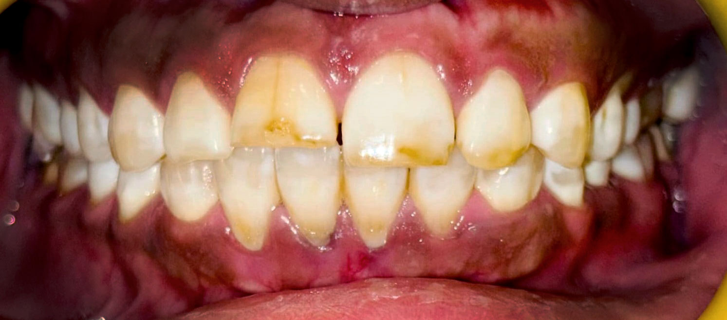 Before teeth whitening